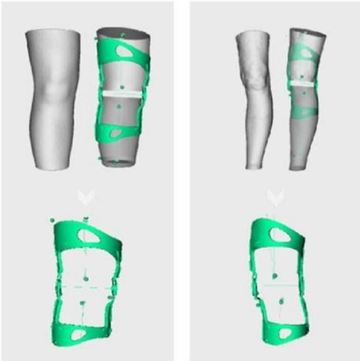 Orthèses de genou sur mesure  Ortho applications - Orthoapplications